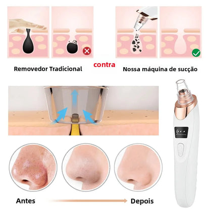 Máquina Removedora de Cravos por Sucção - USB - 3 Níveis Potência