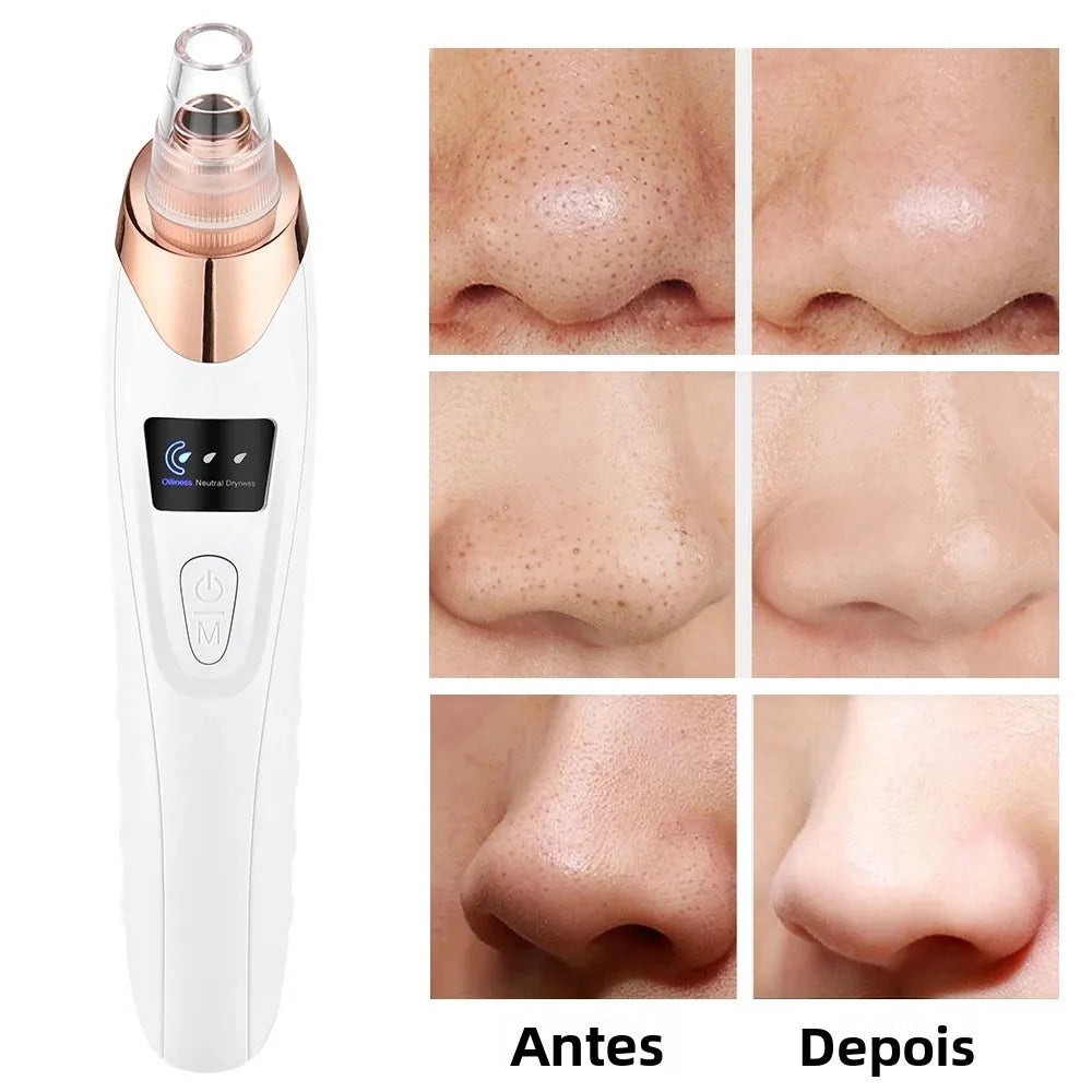 Máquina Removedora de Cravos por Sucção - USB - 3 Níveis Potência